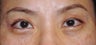 Upper Blepharoplasty