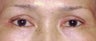 Upper Blepharoplasty