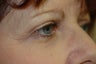 Upper eyelid surgery or blepharoplasty