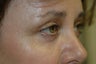 Brow lift, upper and lower eyelid surgery