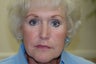 Ptosis repair with upper and lower eyelid surgery