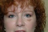 Bilateral upper and lower eyelid surgery