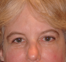 Ptosis repair and eyelid retraction surgery