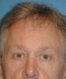 Eyelid Surgery