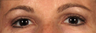 Upper Eyelidplasty with TCA Peel Lower Lids
