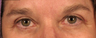 Upper and Lower Eyelidplasty