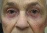 Upper and Lower Blepharoplasty and Cheek Lift