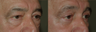 4 Lid Blepharoplasty