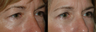 4 Lid Blepharoplasty