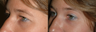 Bilateral Upper Lid Blepharoplasty with Standard Endoscopic Browlift
