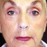 Lower Blepharoplasty