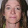 Upper Blepharoplasty