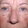 Upper Blepharoplasty