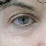Laser Blepharoplasty