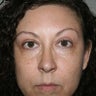 Blepharoplasty