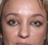 Blepharoplasty