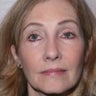 Blepharoplasty