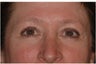 Upper Blepharoplasty