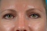 upper lid blepharoplasty (eyelid lift)