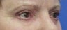 Eyelid Surgery