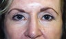 Blepharoplasty