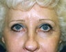 Blepharoplasty