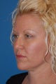 Blepharoplasty or "eyelid lift"