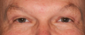 Blepharoplasty