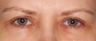 Blepharoplasty (eyelid lift)