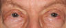 Ptosis and ectropion repair