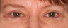 Blepharoplasty (eyelid lift)