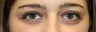 Upper Eyelid Surgery