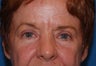 Blepharoplasty