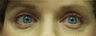 Upper lid blepharoplasty