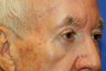 Eyelid Surgery