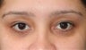 Lower Eyelid Blepharoplasty