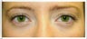 Lower Eyelid Surgery