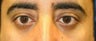 Lower Eyelid Surgery