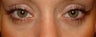 Transconjunctival Lower Eyelid Surgery