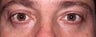 Transconjunctival Lower Eyelid Blepharoplasty
