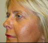 Upper and Lower Eyelid Blepharoplasty