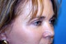 Blepharoplasty