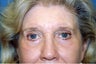 Upper and Lower Blepharoplasty