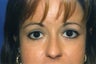 Blepharoplasty