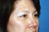 Blepharoplasty