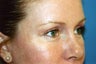 Blepharoplasty