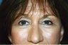 Blepharoplasty