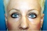 Blepharoplasty