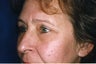 Blepharoplasty