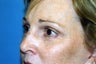 Blepharoplasty